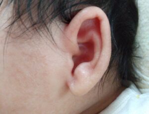 2ヶ月の向き癖がある赤ちゃんの耳が臭い&耳だれ→中耳炎？と思ったけど乳児湿疹かも？